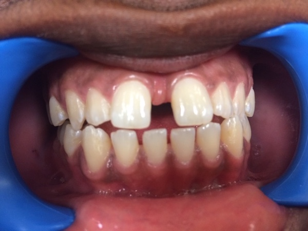 Clear Aligner Treatment West Palm Beach Florida