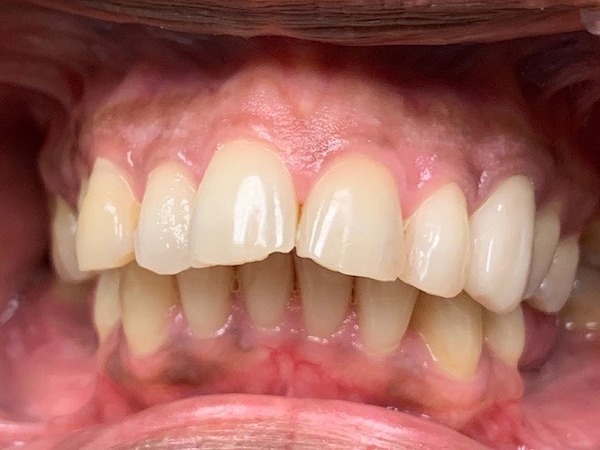 Invisalign Bite Repair West Palm Beach Dentist