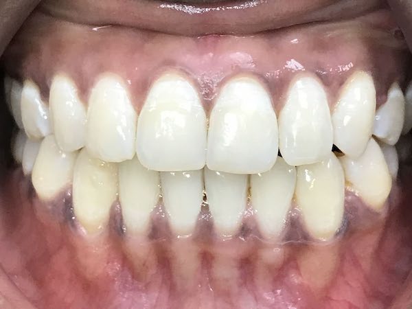 West Palm Beach Florida Invisalign Clear Aligners