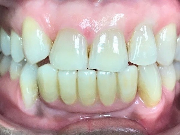 West Palm Beach Florida Invisalign Treatment Dentists