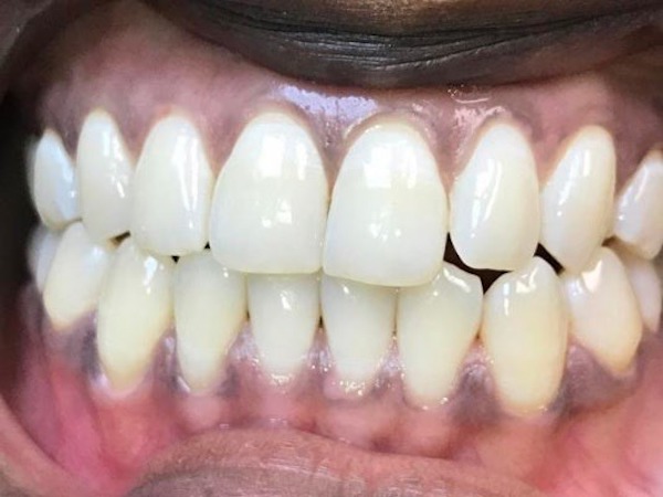 West Palm Beach Invisalign Clear Aligners