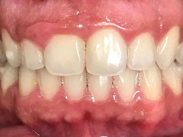 West Palm Beach Smile Restorations