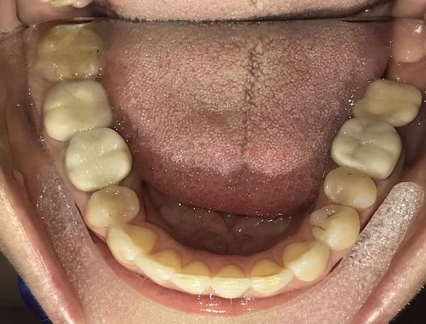 West Palm Beach Teeth Crowding Dentists